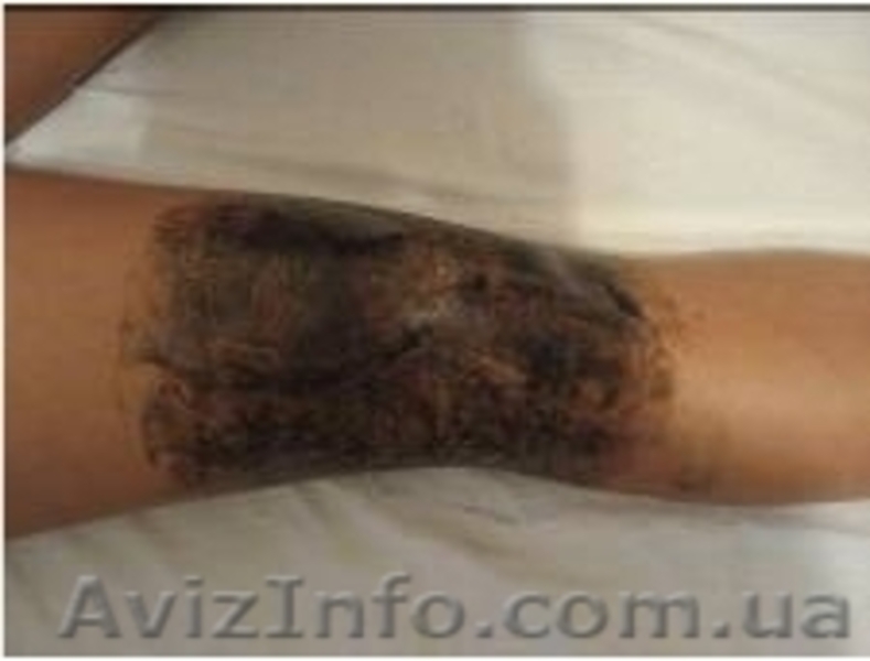 Аппликации с лечебной грязью Сакского озера  - <ro>Изображение</ro><ru>Изображение</ru> #1, <ru>Объявление</ru> #531405